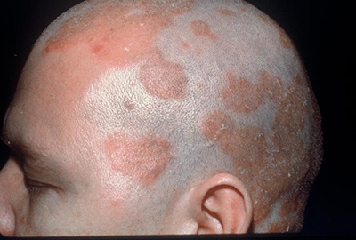 脂漏性皮膚炎の画像