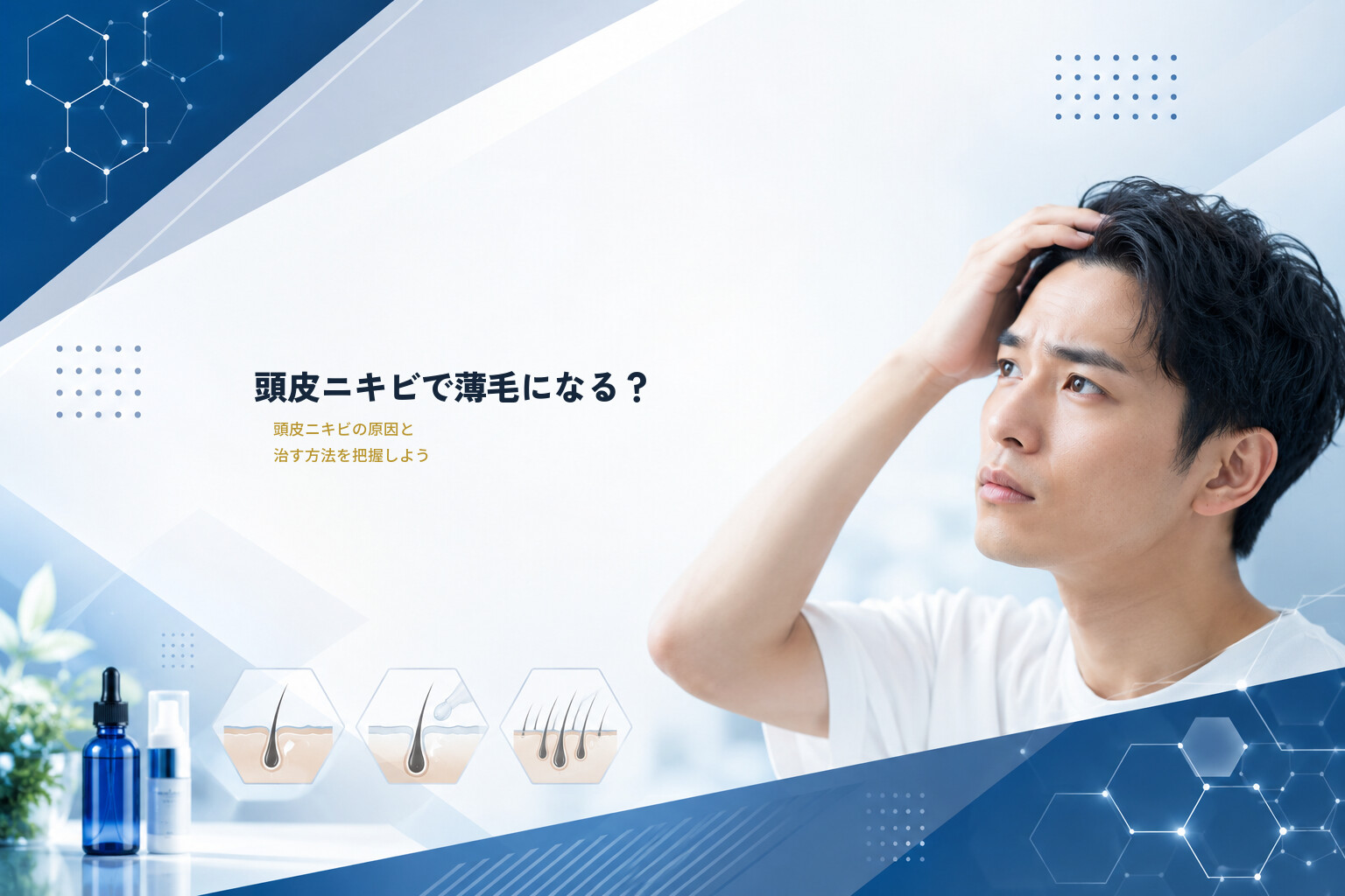 頭皮ニキビで薄毛になる？頭皮ニキビの原因と治す方法を把握しよう